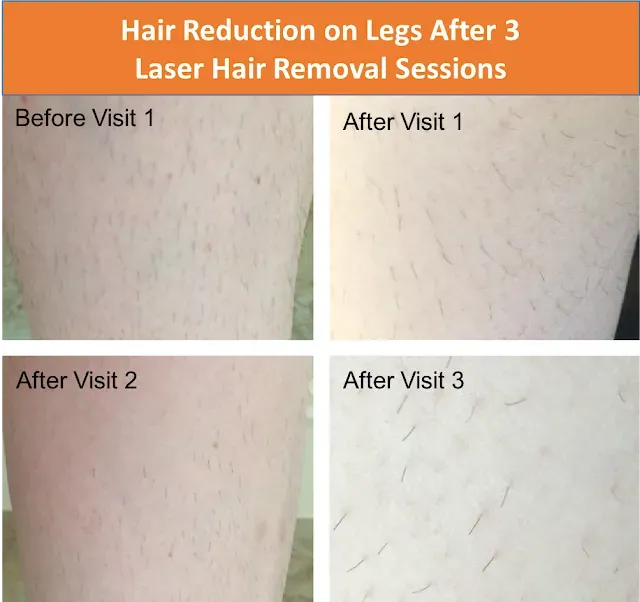 Why Your Brazilian Laser Hair Removal Results After 3 Sessions Aren't Final